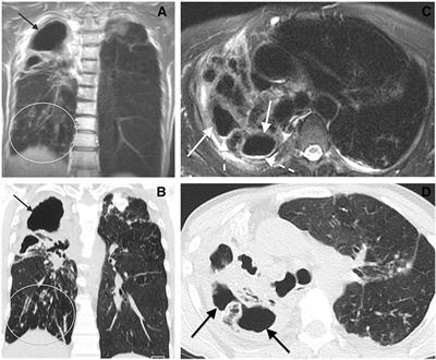 Assessing Response to Therapy for Nontuberculous Mycobacterial Lung Disease: Quo Vadis?